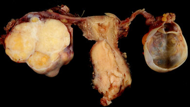 Gebaermutterkrebs_Ed_Uthman_CC_BY_2_0_15062016.jpg Gebärmutterkrebs