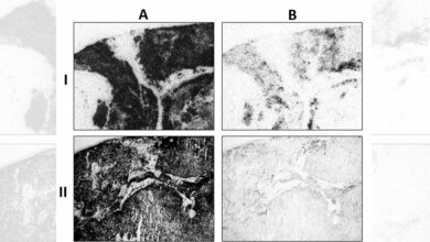 Bild_zeigt_die_von_einem_Antagonisten_gemessene_Menge_an_SST2_Rezeptoren_Jean_Claude_Reubi_Universitaet_Bern.jpg gemessene Menge an SST2-Rezeptoren