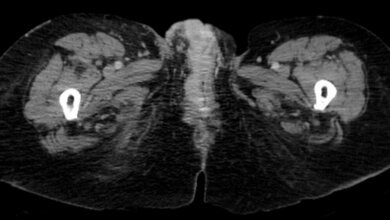 Vulvakarzinom_rechts_-_CT_axial_von_Hellerhoff_CC_BY_SA_3_Wikimedia_Commons_14032016.jpg Vulvakarzinom in der CT