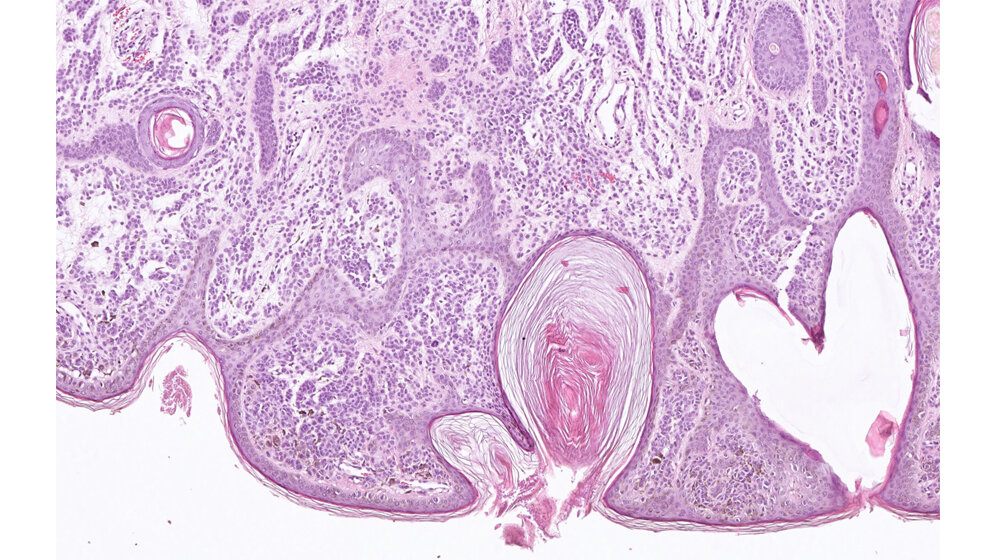 Histopathologisches_Praeparat_eines_gutartigen_Muttermals_Naevus_NCT_Heidelberg_Titus_Brinker.jpg Histopathologisches Präparat eines gutartigen Muttermals