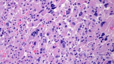 Nebennierenkarzinom_Schnitt_blaue_Bereiche_Zellkerne_Zytoplasma_lila_eingefaerbt_Uniklinikum_Wuerzburg_19052016.jpg Nebennierenkarzinom-Schnitt