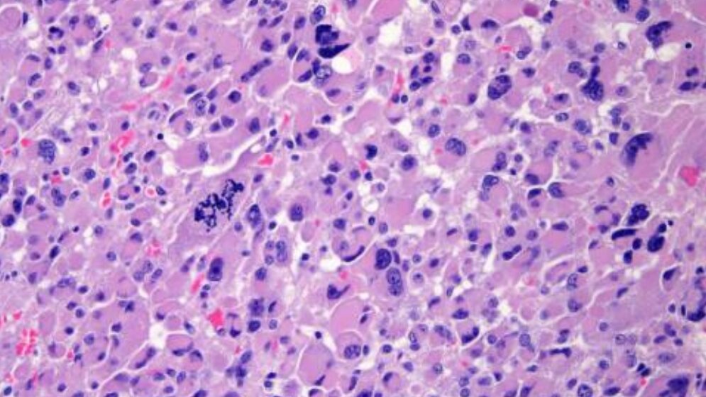 Nebennierenkarzinom_Schnitt_blaue_Bereiche_Zellkerne_Zytoplasma_lila_eingefaerbt_Uniklinikum_Wuerzburg_19052016.jpg Nebennierenkarzinom-Schnitt