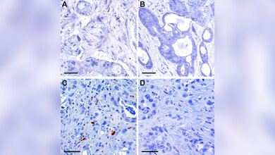 Probe_Bauchspeicheldruesenkrebs.jpg Probe Bauchspeicheldrüsenkrebs