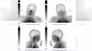 Fehlende_Hirnperfusion_in_der_Hirnperfusionsszintigrafie_Von_Drahreg01_CC_BY_SA_3_0.jpg Fehlende Hirnperfusion