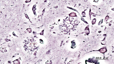 Alzheimer_dementia_presenile_onset_KGH_CC_BY_SA_3via_Wikimedia_02022016.jpg Senile Plaques