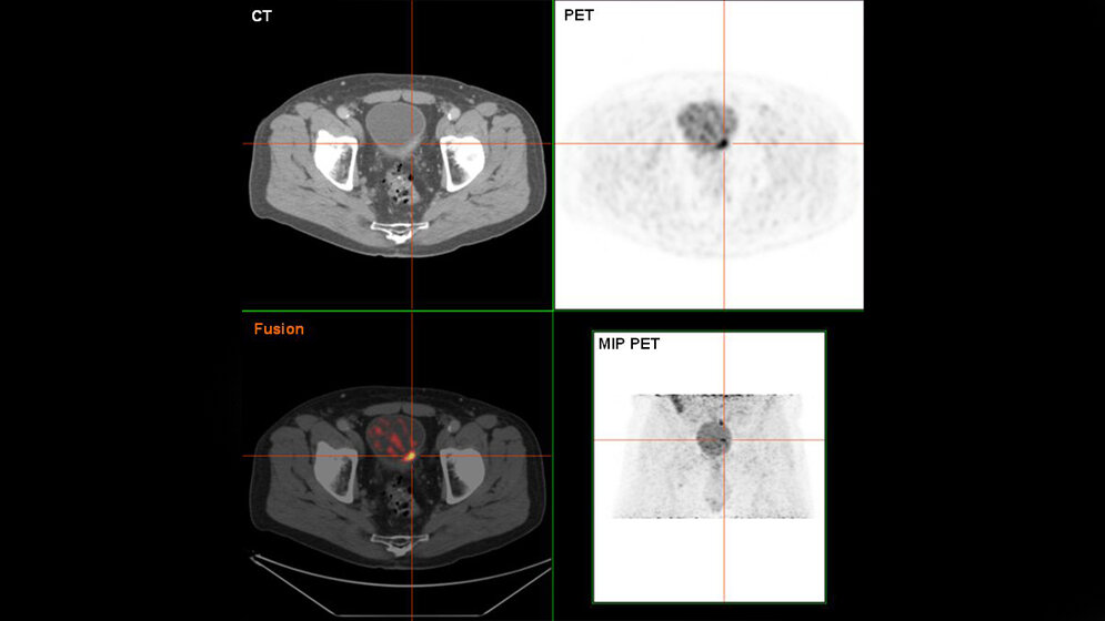 Blasenkrebs_in_der_FDG_PET_CT_Darstellung_Hg6996__Eigenes_Werk_Gemeinfrei_wikimedia.jpg Blasenkrebs in der FDG-PET/CT-Darstellung