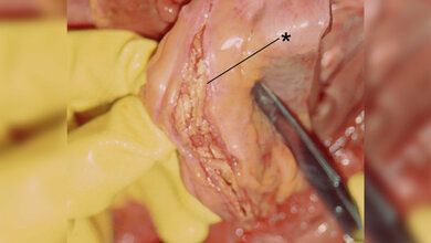 AoDiss_Patho_geschnitten.jpg Aortendissektion