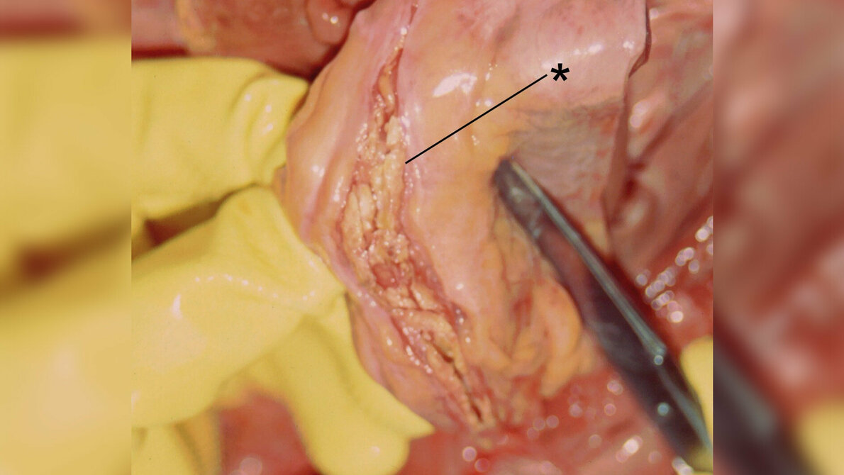 AoDiss_Patho_geschnitten.jpg Aortendissektion
