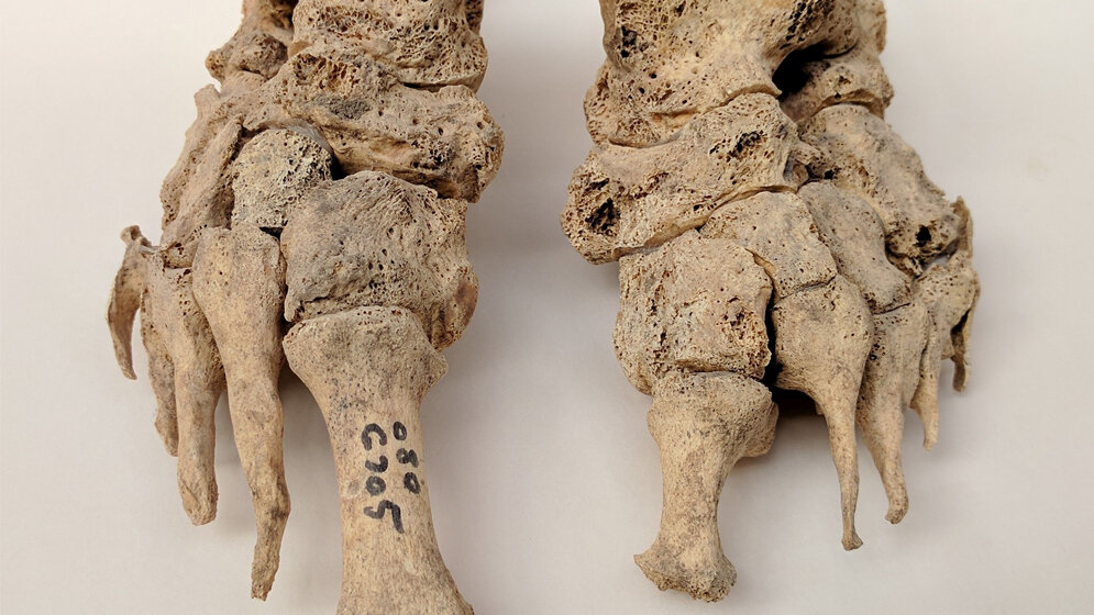 Lepra_Dorthe_Pedersen.jpg Lepra