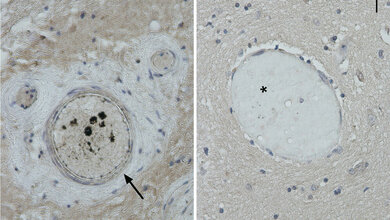 Schaedel_Hirn_Verletzte_Gefaessverschluesse_Pfeil_gesunde_Menschen_Stern_14042016.jpg Schädel-Hirn-Verletzungen