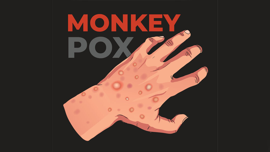 Mpox_Dtl.jpg Hand mit Mpox