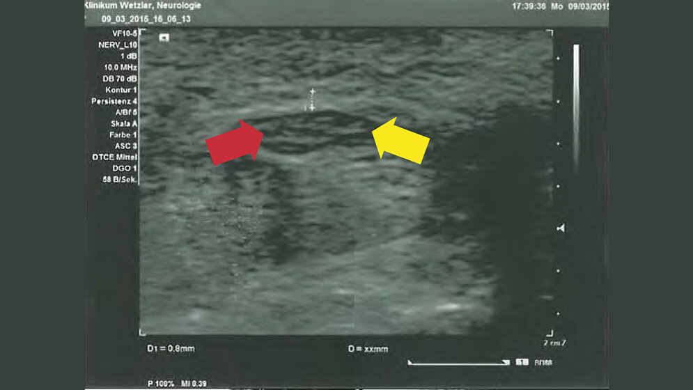 Sonographie des Nervus medianus und des Nervus ulnaris – ein Überblick Neurologie