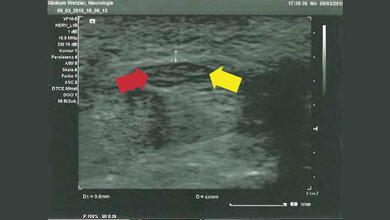 Sonographie des Nervus medianus und des Nervus ulnaris – ein Überblick Neurologie