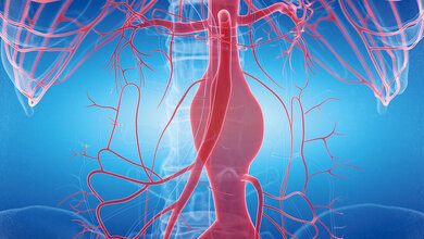 Erkrankungen der Aorta Illustration eines Aneurysmas (sackförmige Erweiterung des Gefäßes)