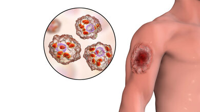 Leishmaniose.jpg Symbolbild für kutane Leishmaniose.