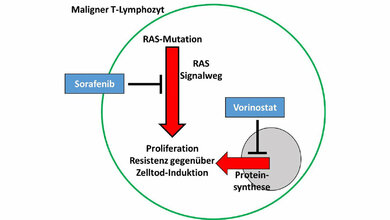 Schematische_Darstellung_eines_malignen_T_Lymphozyten_des_Sezary_Syndroms_PD_Dr_Karsten_Guelow.jpg Schematische_Darstellung_eines_malignen_T_Lymphozyten_des_Sezary_Syndroms_PD_Dr_Karsten_Guelow.jpg