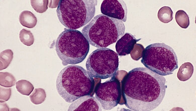 Blasten_AML_FAB_M1_Von_The_Armed_Forces_Institute_of_Pathology_gemeinfrei_10062016.jpg AML