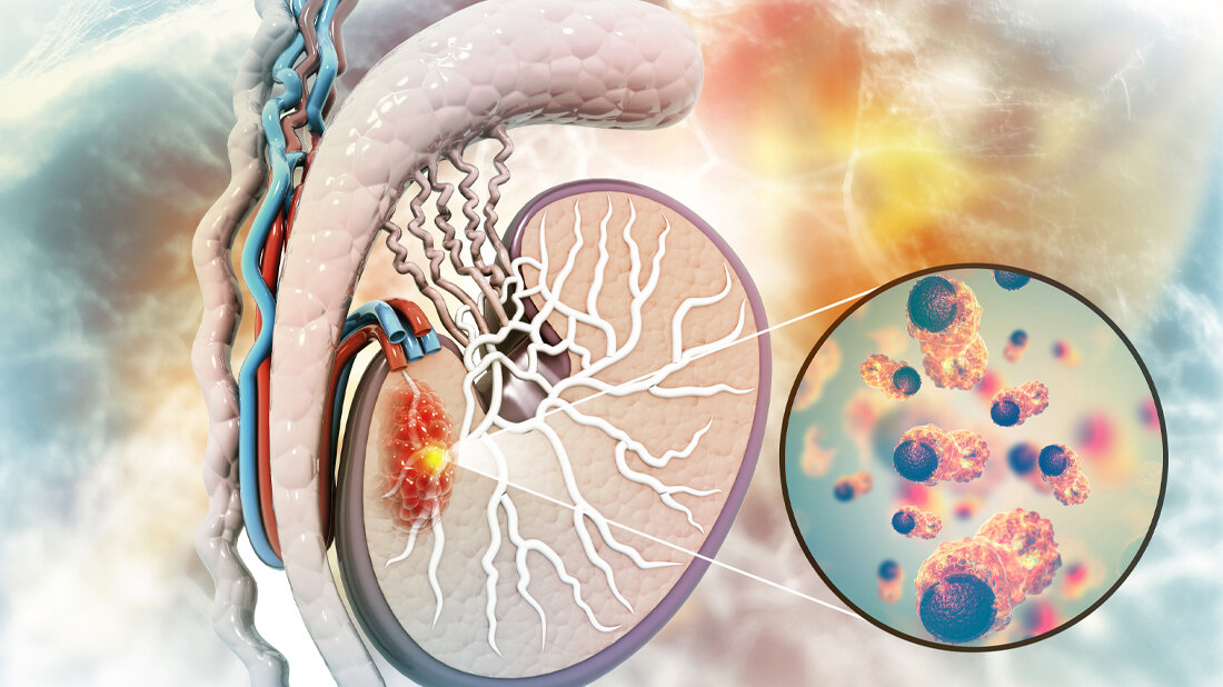 Hodenkrebs_Crystal_light_stock_adobe_com.jpg Hodenkrebs