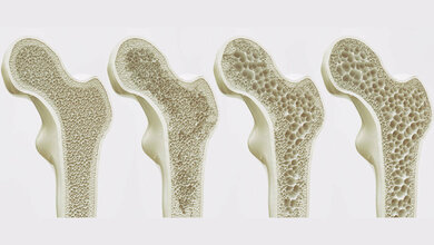 Osteoporose_erkennen.jpg Stufen der Osteoporose