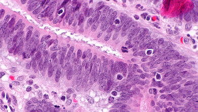 Dickdarmkrebs_mit_Lymphozyten_Nephron_Eigenes_Werk__CC_BY_SA_3_0_Wikimedia.jpg Dickdarmkrebs mit Lymphozyten im Tumor, HNPCC