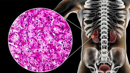Nierenzellkarzinom: S3-Leitlinie Aktualisiert - MT-Dialog