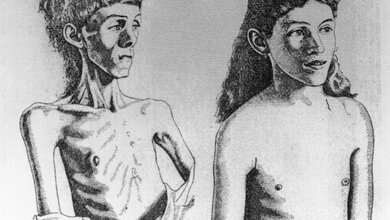 Anorexia_nervosa_Von_wellcomeimages_org_CC_BY_4_0_e6ec500743.jpg Anorexia nervosa