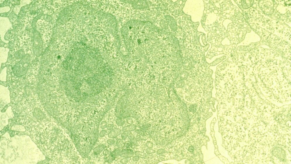 Hairy_cell_leukemia_Unbekannter_Fotograf_Public_domain_via_Wikimedia_Commons_21032016.jpg Haarzell-Leukämie