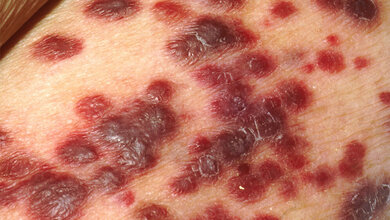 Kaposi_Sarkom_auf_der_Haut_eines_AIDS_Patienten_National_Cancer_Institute_gemeinfrei.jpg Kaposi-Sarkom