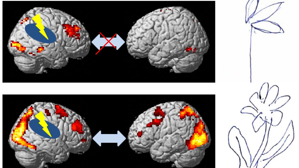 Ein_Schlaganfall_fuehrt_haeufig_zu_raeumlichen_Wahrnehmungsstoerung_Universitaetsklinikum_Freiburg_29032016.jpg Ein Schlaganfall führt häufig zu einer räumlichen Wahrnehmungsstörung.