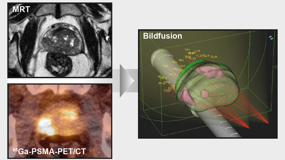 unterschiedlichste_Bildgebungsmethoden_mit_Echtzeit_Ultraschallbild_fusioniert_Universitaetsklinikum_Freiburg.jpg Bildgebungsmethoden mit Echtzeit-Ultraschallbild fusioniert
