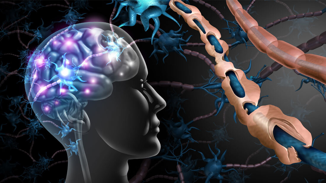 Multiple_Sklerose.jpg Multiple Sklerose