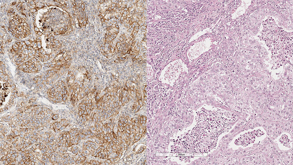 Hämatologie/Zytologie Optimierung und Validierung von PD-L1-Färbeprotokollen am Beispiel E1L3N (Teil 3)