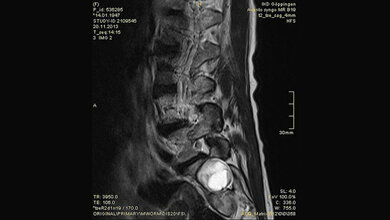 Tumoröse Veränderungen: Aneurysmatische Knochenzyste Schnittbilddiagnostik der Wirbelsäule (4.16)