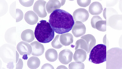 Blutausstrich_einer_Vorleukaemie_bei_einem_Kind_mit_Down_Syndrom_Jan_Henning_Klusmann.jpg Blutausstrich einer Vorleukämie