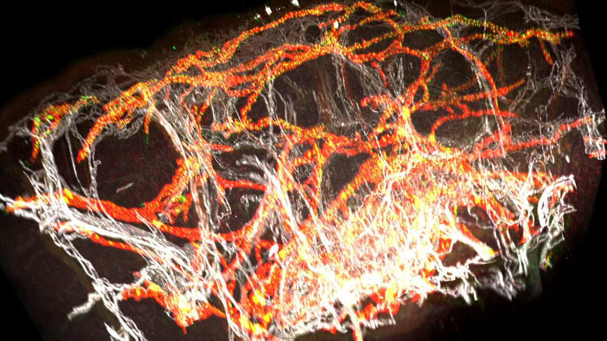 3D_Bild_eines_Lymphödems.jpg 3D-Hautbiopsie