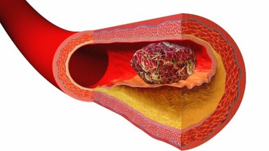 Blutgerinnsel_Blausen_com_staff_Blausen_gallery_2014_Wikiversity_Journal_of_Medicine_14042016.jpg Blutgerinnsel