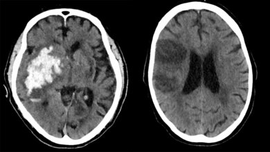 Schlaganfall_Klinik_für_Radiologie_und_Neuroradiologie.jpg CT-Aufnahmen des Gehirns von Personen mit Schlaganfall