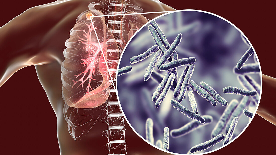 Welttuberkulosetag.jpg Leichter Anstieg der Tuberkulosefälle in Deutschland: Braucht es mehr Kontrollen?