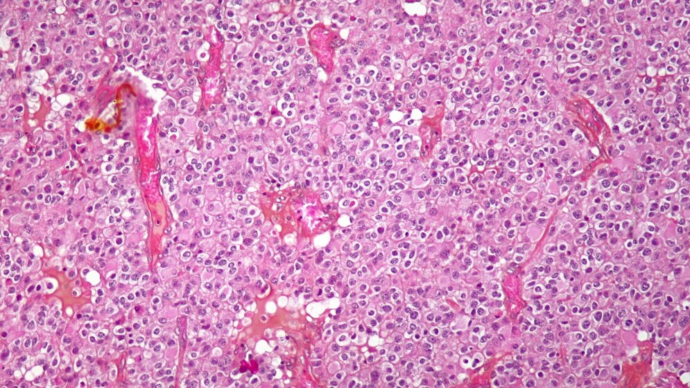 Oligodendroglioma_Von_Nephron_Eigenes_Werk_CC_BY_SA_3_0_11052016.jpg Oligodendrogliom