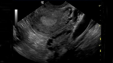 Polyzystisches_Ovar_Syndrom_By_Schomynv_Own_work_CC0.jpg Polyzystisches Ovar-Syndrom