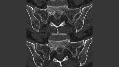 Aufnahme_des_Beckens_einer_Brustkrebspatientin_mit_Knochenmetastasen_Wehrse_DKFZ.jpg Aufnahme des Beckens einer Brustkrebspatientin