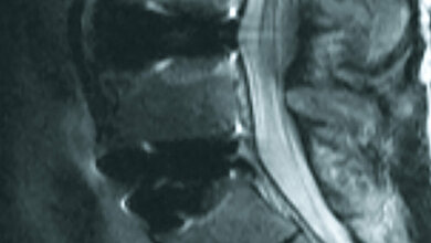 Bildgebende Verfahren Postoperative Veränderungen: Spondylodese, Bandscheibenersatz und Interspacer