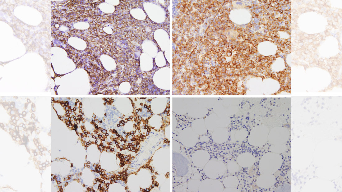 CD138_positive_Myelomzellen.jpg CD138-positive Myelomzellen