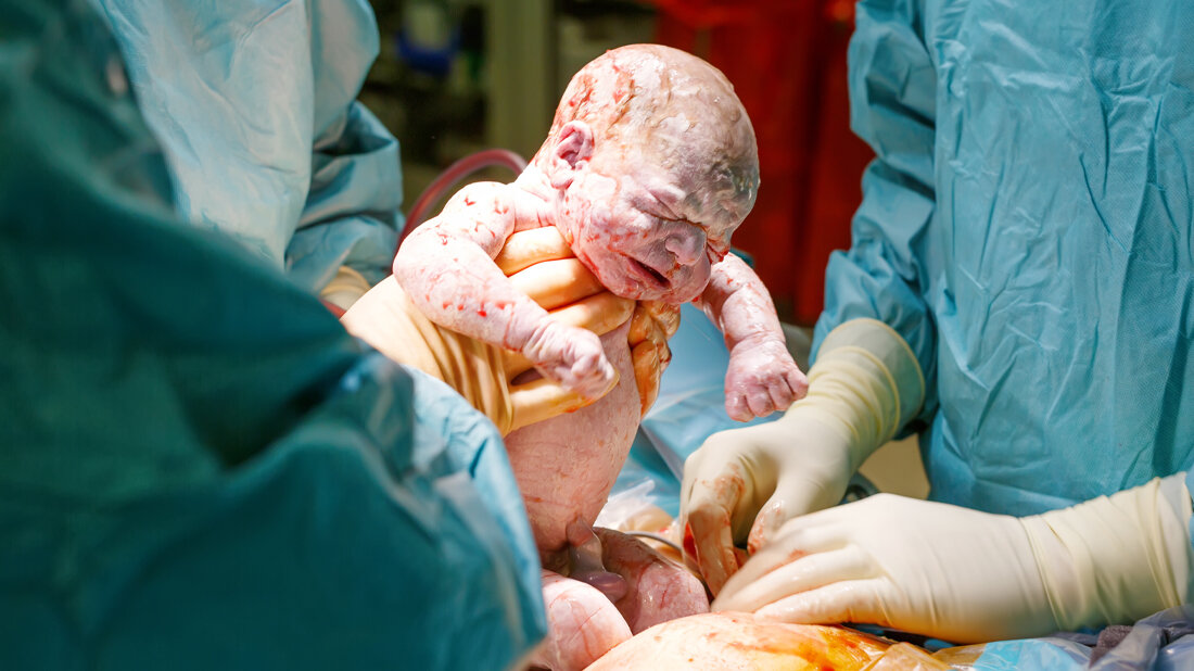 Kaiserschnitt_Adobe.jpg Geburt mit Kaiserschnitt