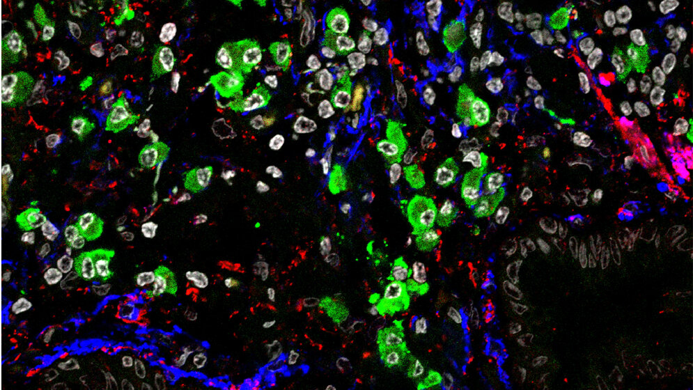 Mikroskopische_Aufnahme_von_vernarbtem_Lungengewebe_HZM_Herbert_Schiller.jpg Mikroskopische Aufnahme von vernarbtem Lungengewebe