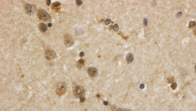 Verklumpungen_des_Huntington_Eiweisses_Dr_Katrin_Lindenberg_Neurologie_Universitaetsklinikum_Ulm_22032016.jpg Verklumpungen des Huntington-Eiweißes