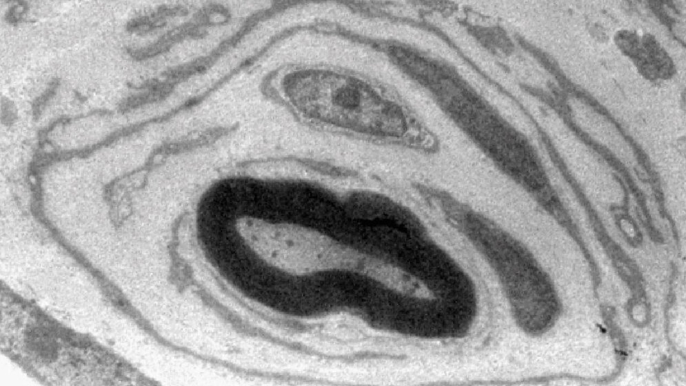 Elektronenmikroskopische_Aufnahme_eines_an_CMT1A_erkrankten_Nervs_Dr_Ruth_Stassart.jpg Elektronenmikroskopische Aufnahme eines an CMT1A erkrankten Nervs