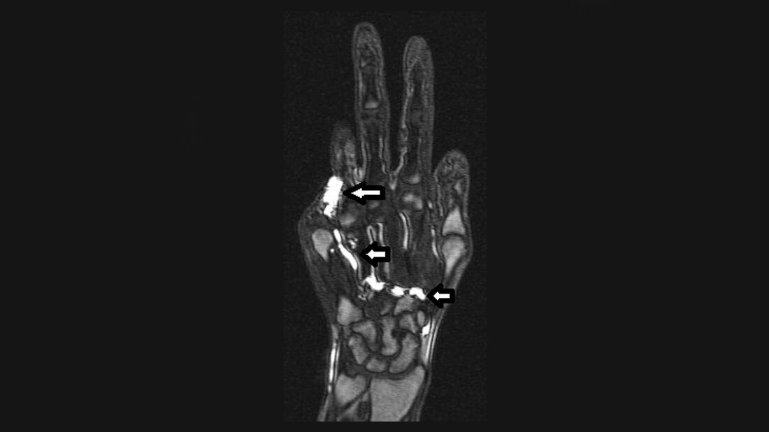 Anomalien und Normvarianten – Vaskuläre Veränderungen 2.27: periphere vaskuläre Malformation Arterielle MRA: Kontrastierung der vaskularen Malformation der Hand