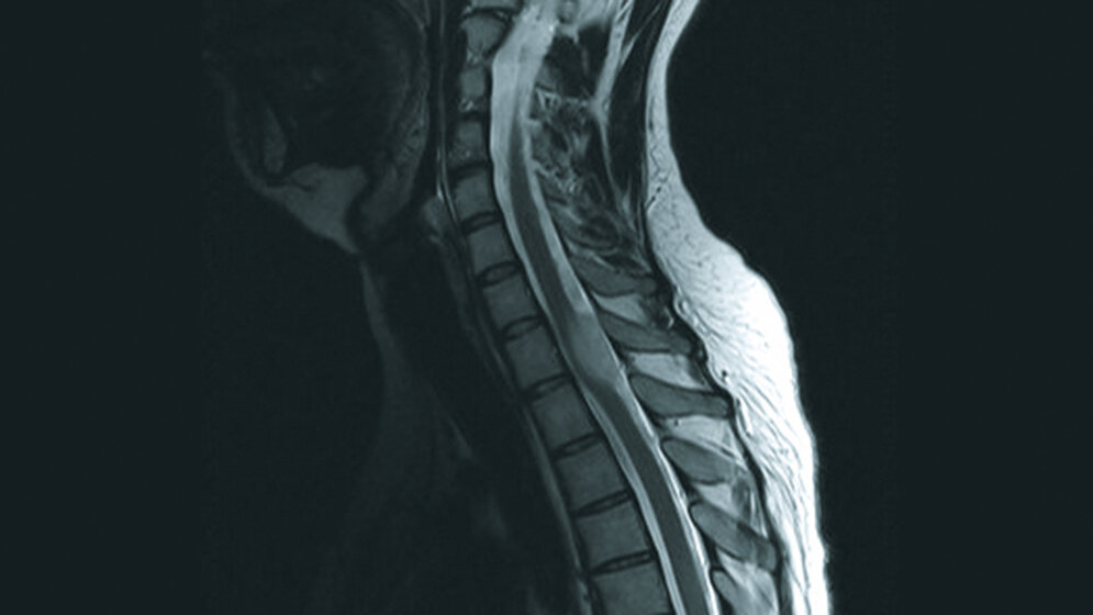 Spinales Astrozytom Schnittbilddiagnostik der Wirbelsäule