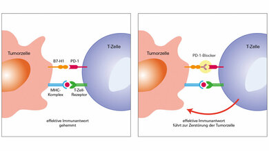 So_wirkt_die_PD_1_Blockade_prinzipiell_Bild_Uniklinikum_Wuerzburg.jpg So_wirkt_die_PD_1_Blockade_prinzipiell_Bild_Uniklinikum_Wuerzburg.jpg